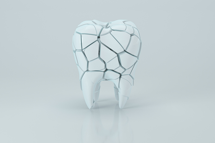 dental erosion 3d