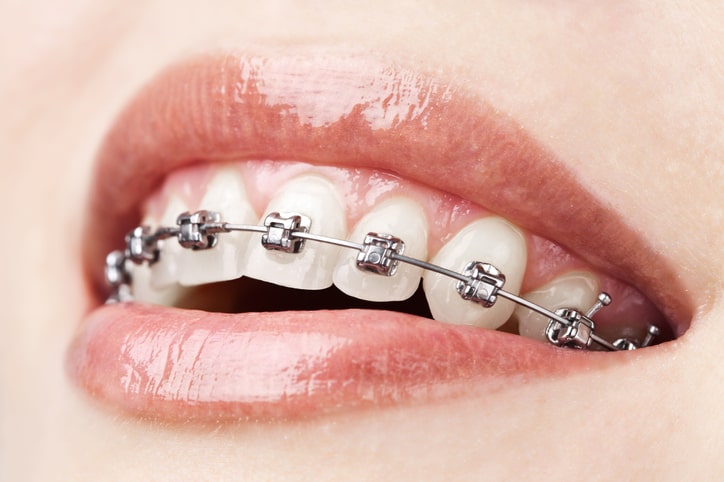 metal braces