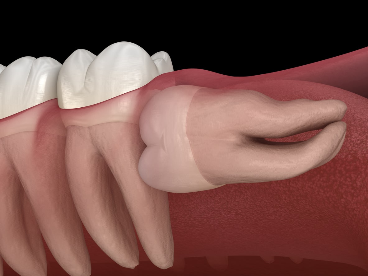 Salo & Salo - Wisdom Teeth Extraction