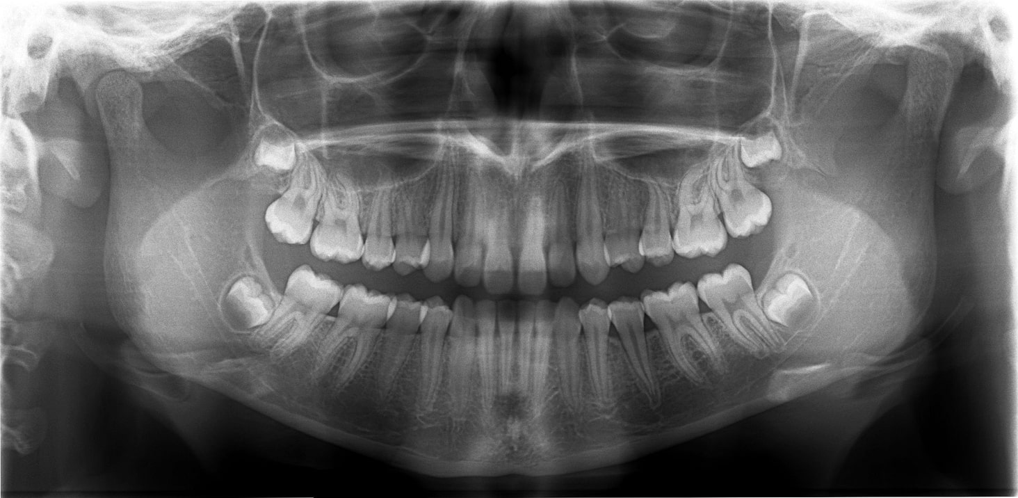 Salo & Salo - Wisdom Teeth Extraction