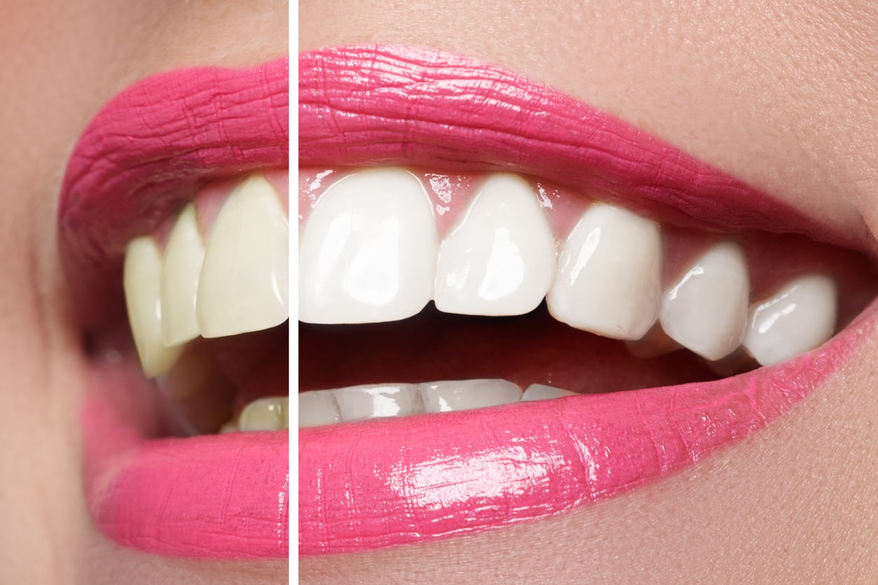 Salo & Salo - Teeth Bleaching
